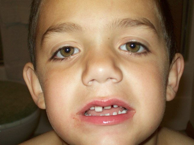 Joshua 5 years tooth injury